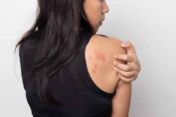 What causes hives?