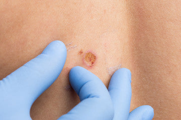 What are the symptoms of skin cancer?