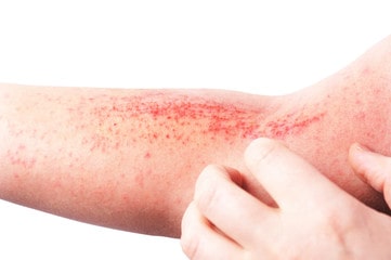 What causes skin inflammation?