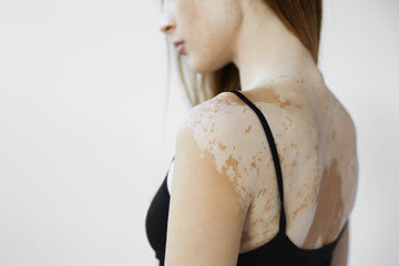 What causes patches of discolored skin?