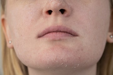 Do you have dehydrated skin?